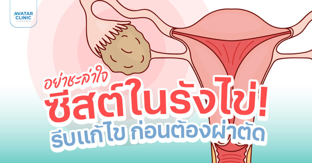 อย่ารอให้สายเกินแก้ จัดการซีสต์ในรังไข่ ก่อนจะกลายเป็นปัญหาที่ต้องผ่าตัด