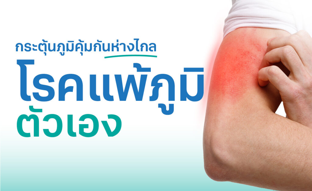 รักษาโรคแพ้ภูมิตัวเอง SLE (Systemic Lupus erythematosus) หรือ Lupus